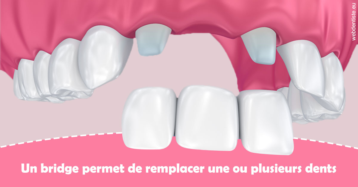 https://dr-patrick-bermot.chirurgiens-dentistes.fr/Bridge remplacer dents 2