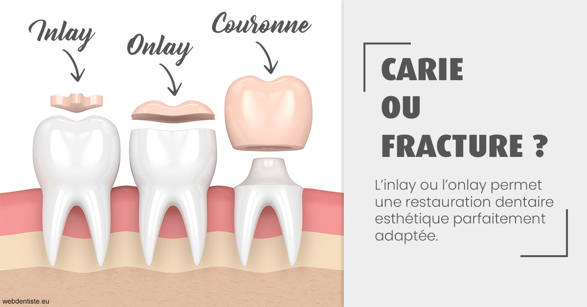 https://dr-patrick-bermot.chirurgiens-dentistes.fr/T2 2023 - Carie ou fracture 1