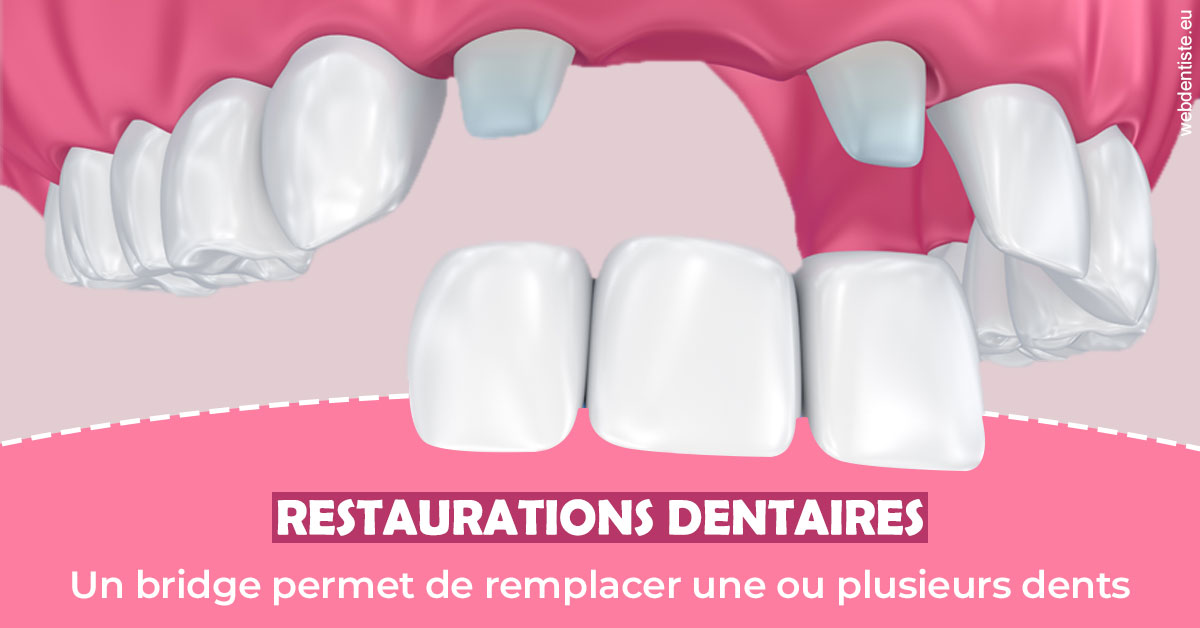 https://dr-patrick-bermot.chirurgiens-dentistes.fr/Bridge remplacer dents 2