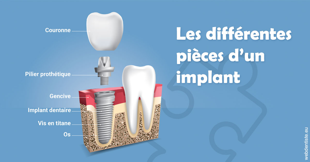 https://dr-patrick-bermot.chirurgiens-dentistes.fr/Les différentes pièces d’un implant 1
