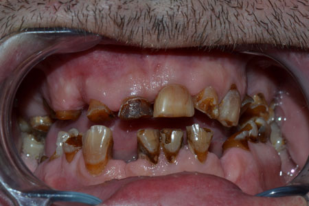 Prothese-dentaire-3-avant