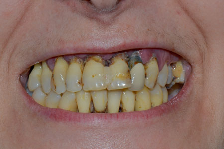 Prothese-dentaire-1-avant