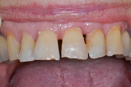 Prothese-dentaire-2-avant