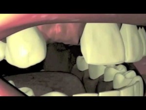 Remplacement d'une dent manquante à l'aide d'un mini-implant